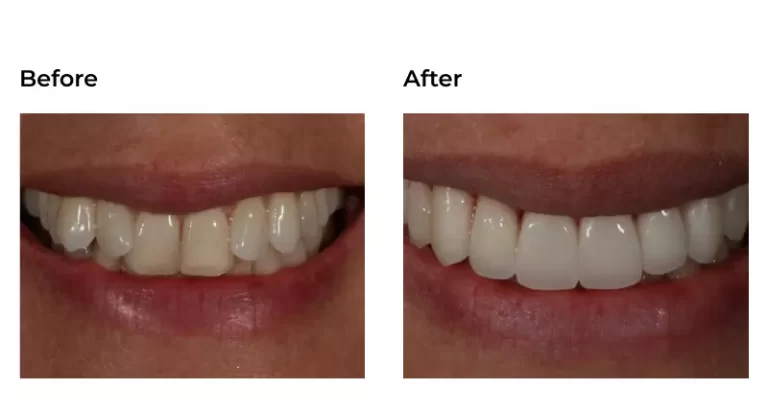 Before and Afters - Smile Center