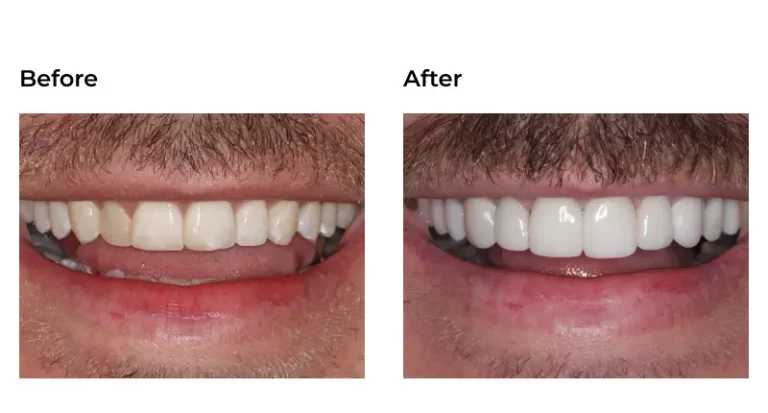 Before and Afters - Smile Center