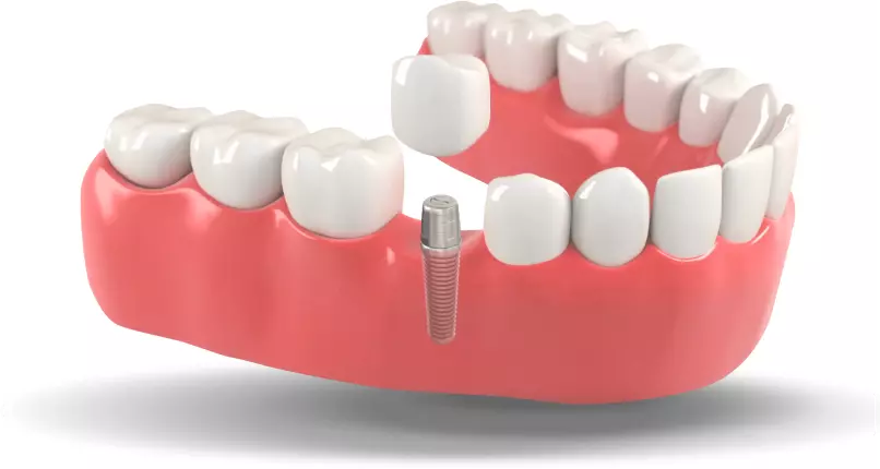 Single Implant - Dental Services with Smile Center