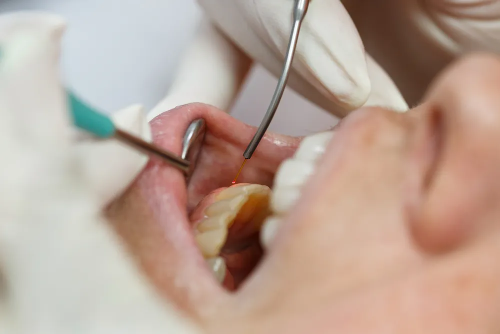Soft Tissue Laser Dentistry Solutions in CT